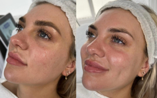 pure hydro women on bed treatment